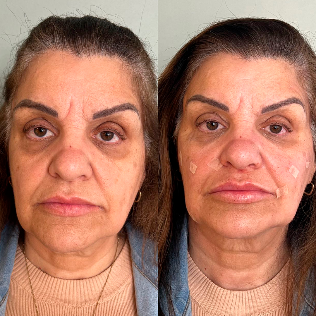 Antes e depois - Caso 1